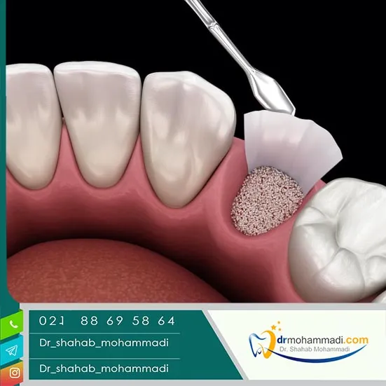 چرا پیوند استخوان فک کلید موفقیت ایمپلنت دندان است؟
